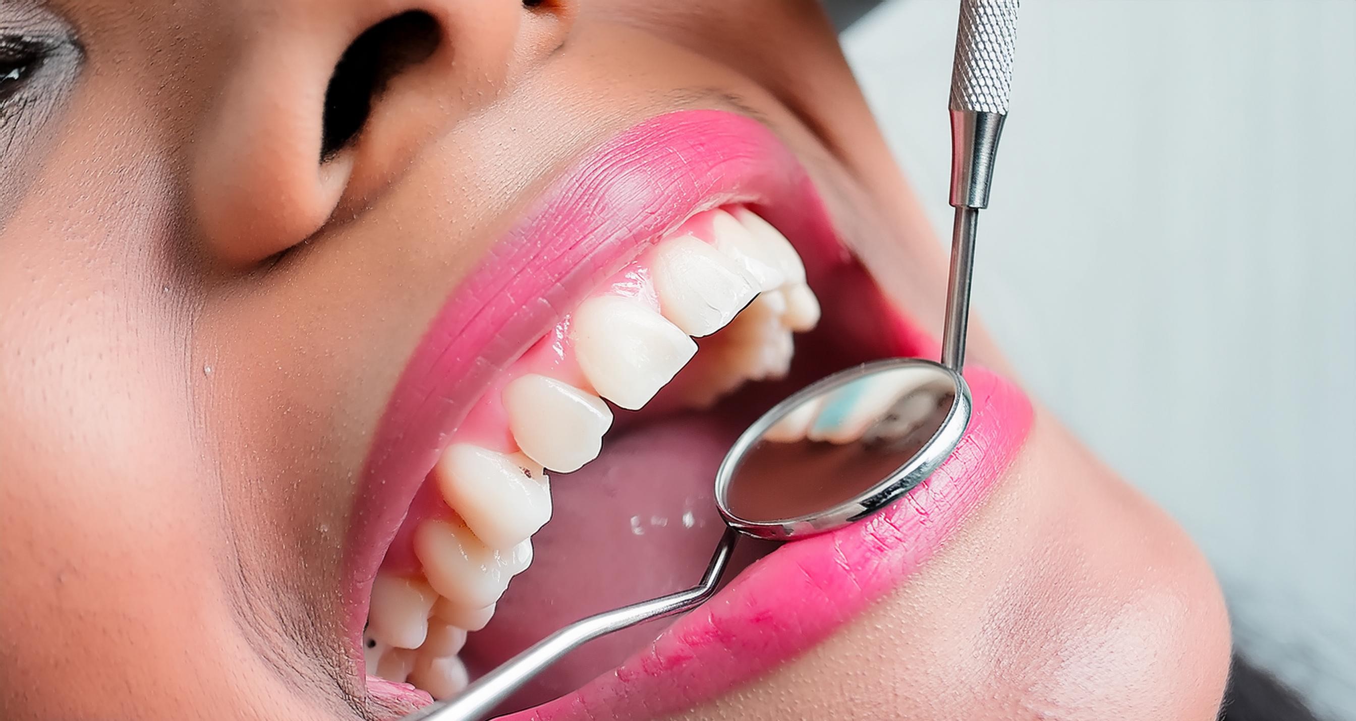 Cavities'( Tooth Decay)- Causes, Treatment and Prevention 