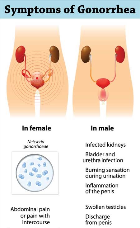 symptoms of gonorrhea 