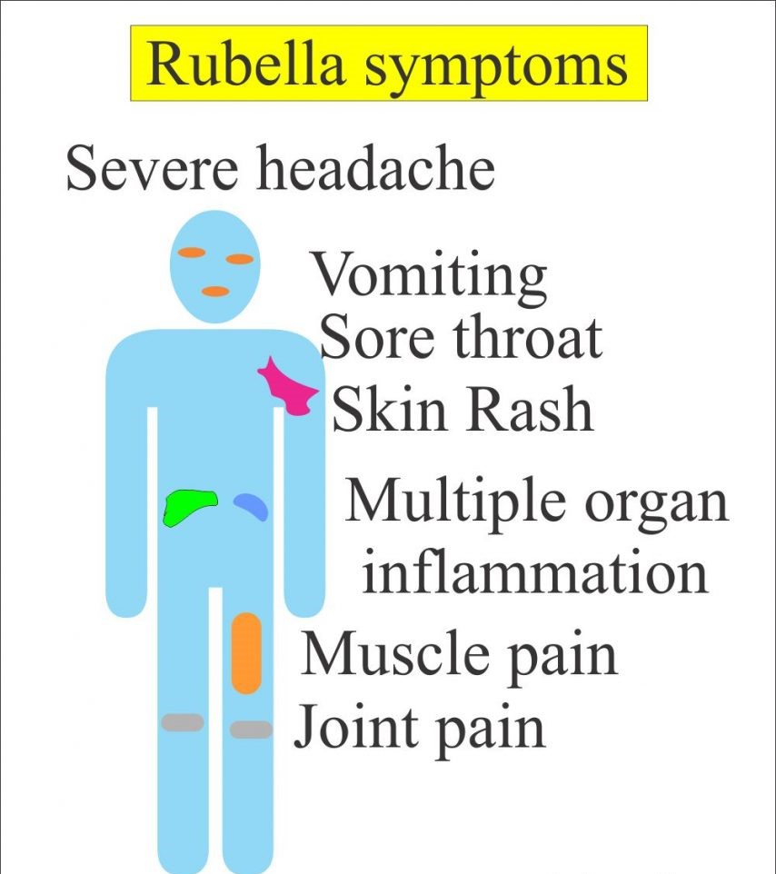 Rubella virus symptoms image
