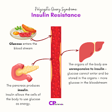 insulin resistance image