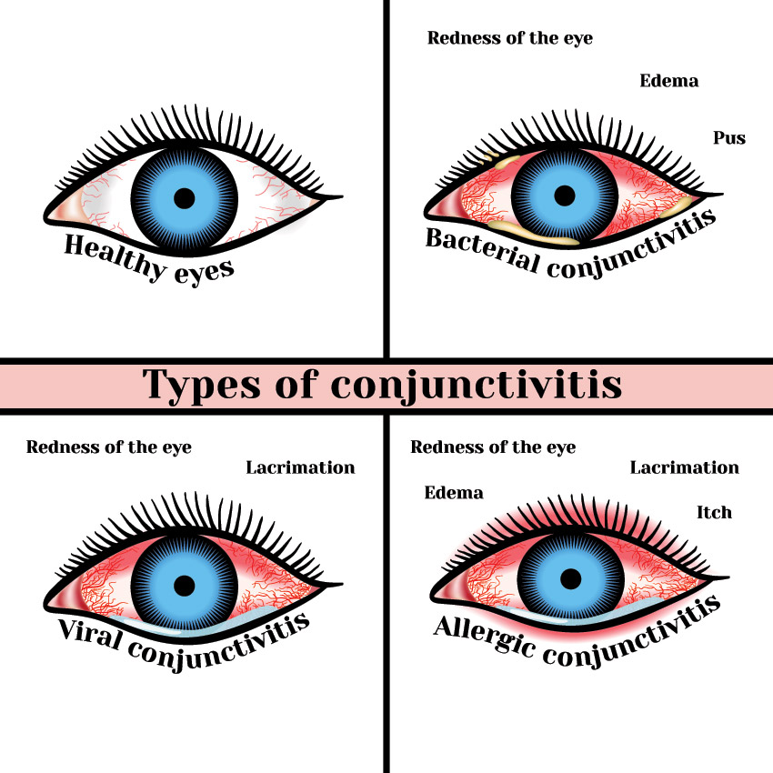 Types of conjunctivitis image