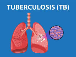 tuberculosis image