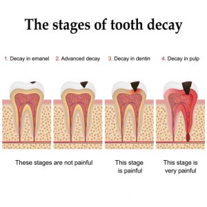 stages in tooth decay