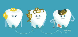 Tooth decay image