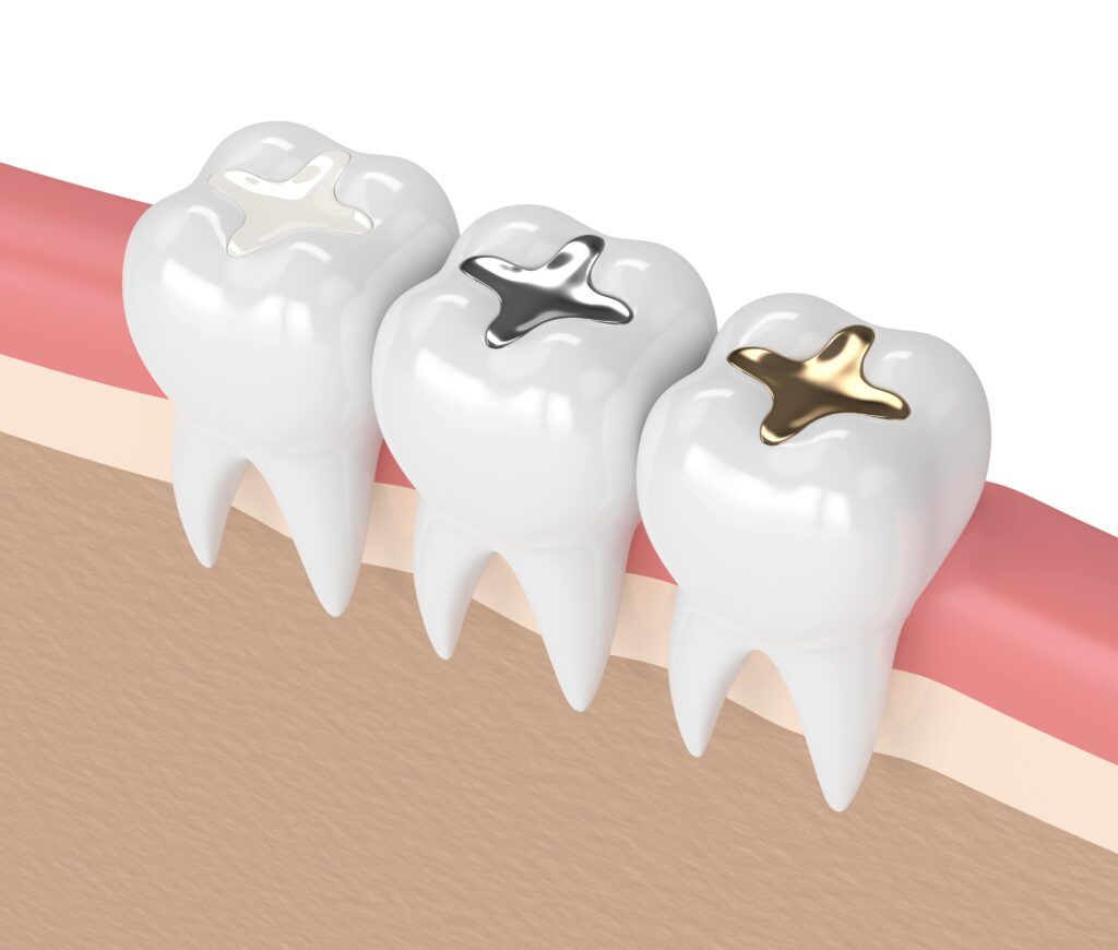 dental filling image