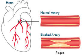 Coronary Artery Disease Image