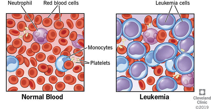 Leukemia image