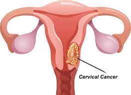 cancerous cervix image
