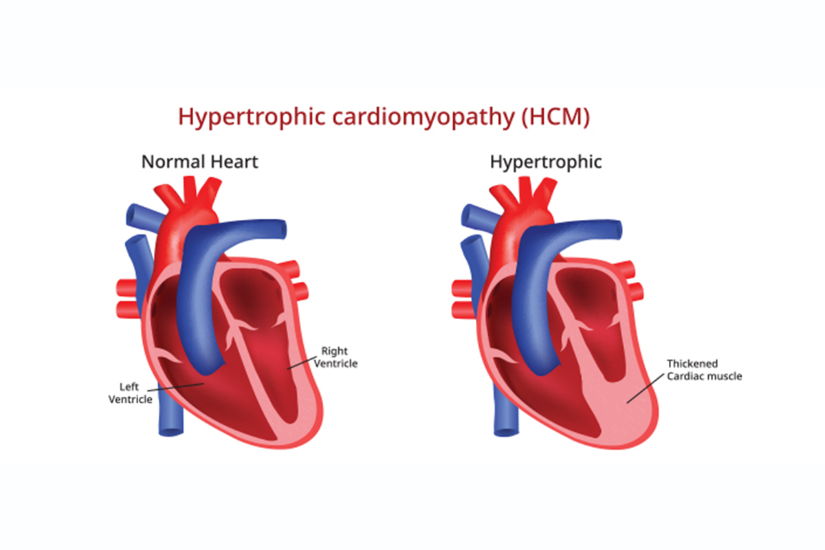 heart HCM