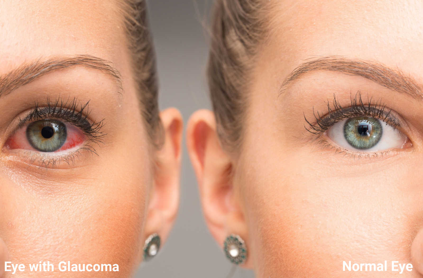 glaucoma images