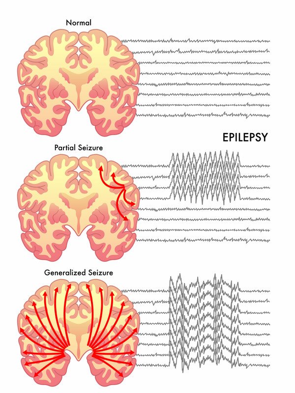 Epilepsy image