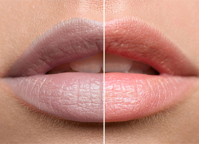Lip discoloration due to smoking 