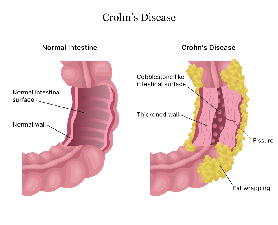 Crohn’s disease