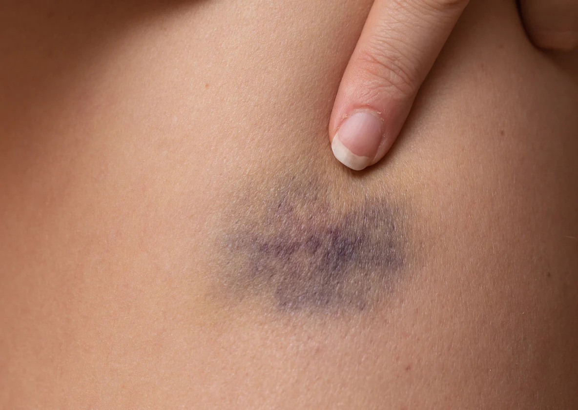 A bruise 