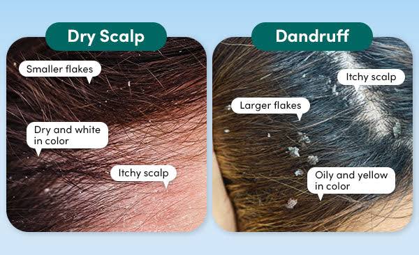 dandruff and dry scalp